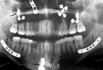 Dental plates and screws