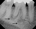 Periodontal abscess