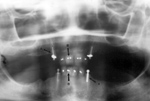 Root canals and porcelain
