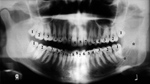 Tooth nomenclature