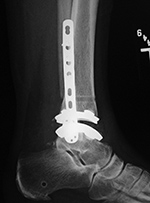 Zimmer trabecular metal TAR