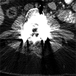 Streak artifact